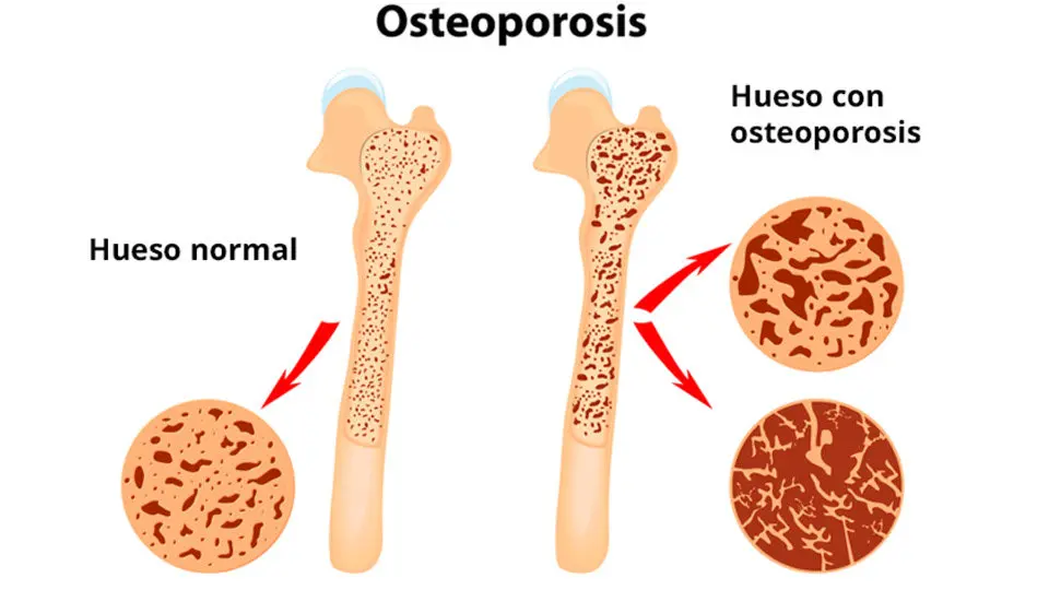 Osteoporosis