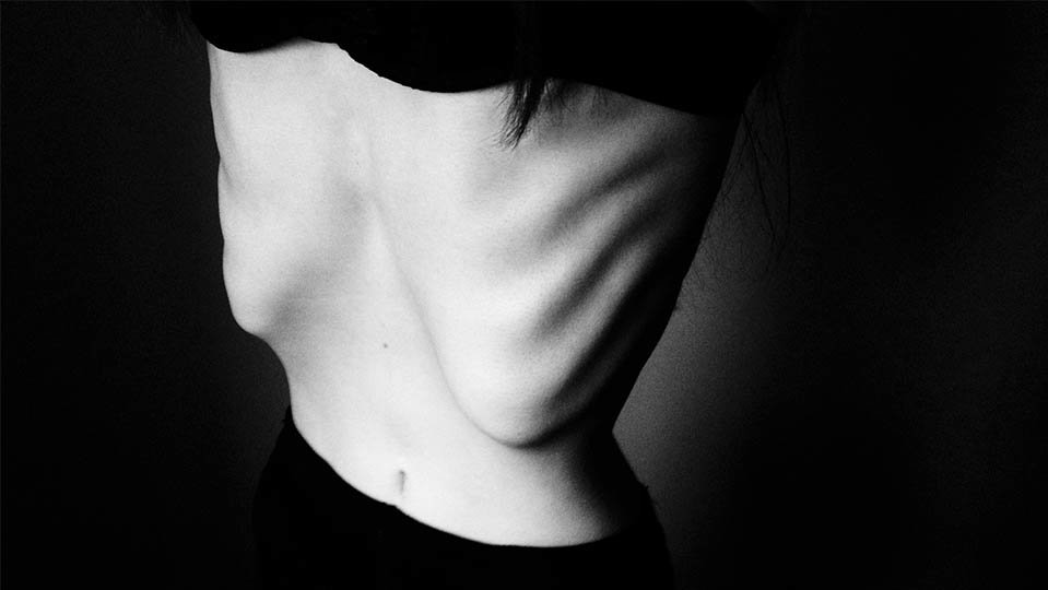 uned tudela anorexia nerviosa