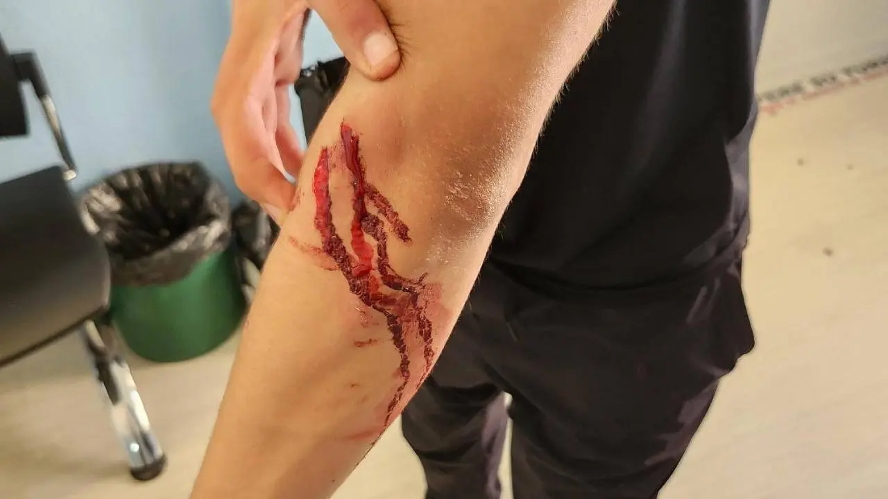 Corte sangrante en el brazo de un joven. foto Polic&iacute;a Local de Tudela