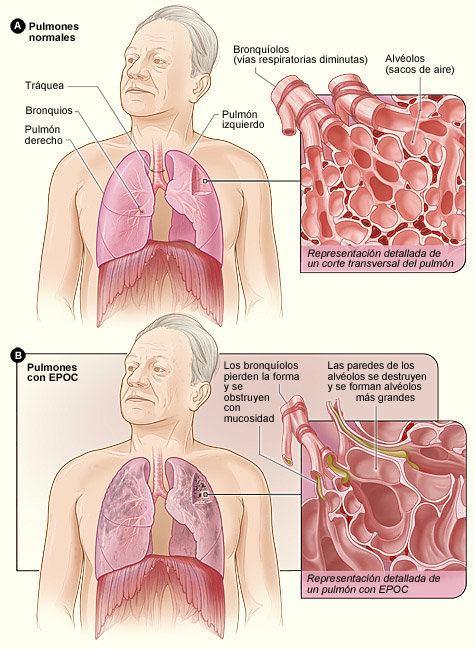 pulmones con EPOC