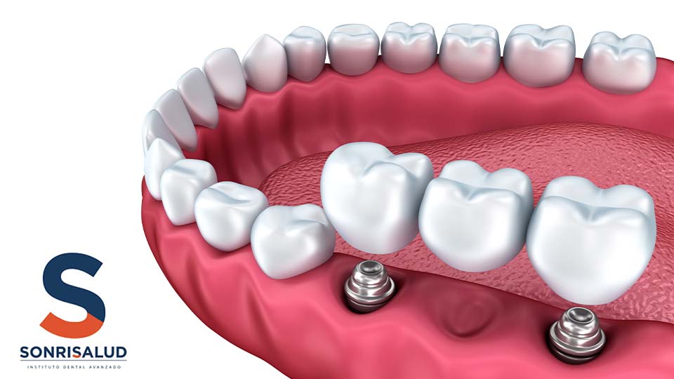 Implantología dental Sonrisalud